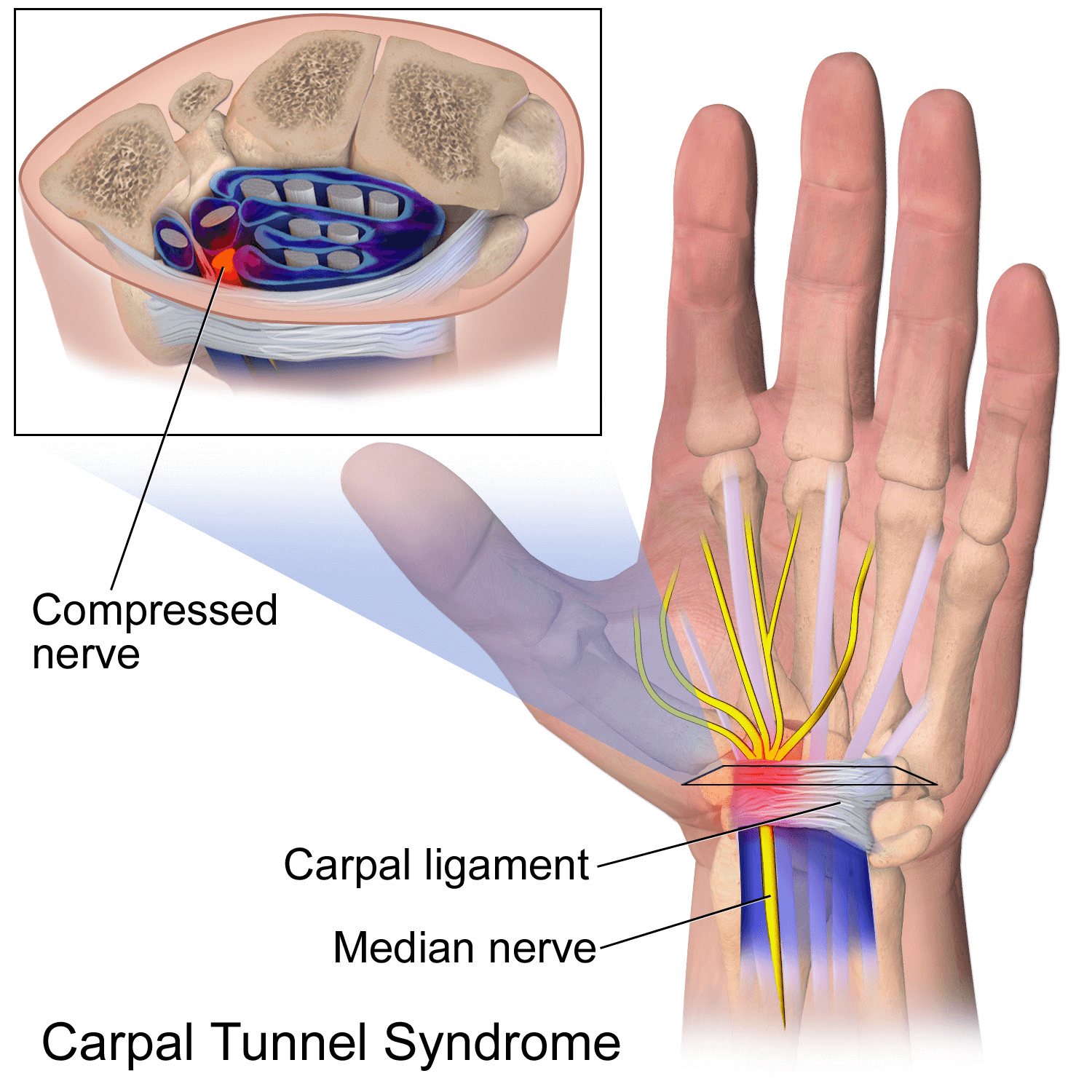 carpal tunnel release